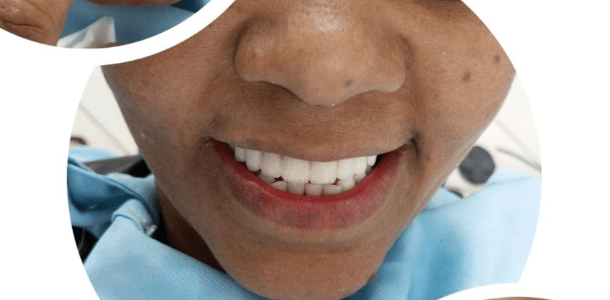 After - Molar with deep decay treated with root canal and crowned for long-term protection.