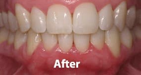After - Patient with moderate periodontitis treated with deep cleaning and laser therapy.