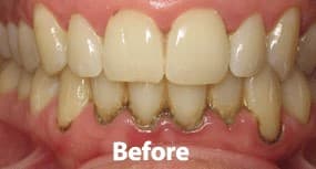 Before - Patient with moderate periodontitis treated with deep cleaning and laser therapy.