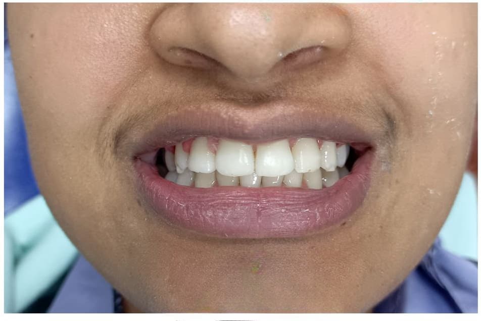 After - Teen patient with severe crowding successfully treated with metal braces over 18 months.