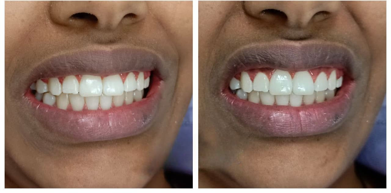 After - Adult patient corrected overbite using Invisalign over a 14-month period.