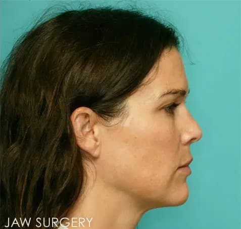 After - Receding jaw fixed with jaw sugery.