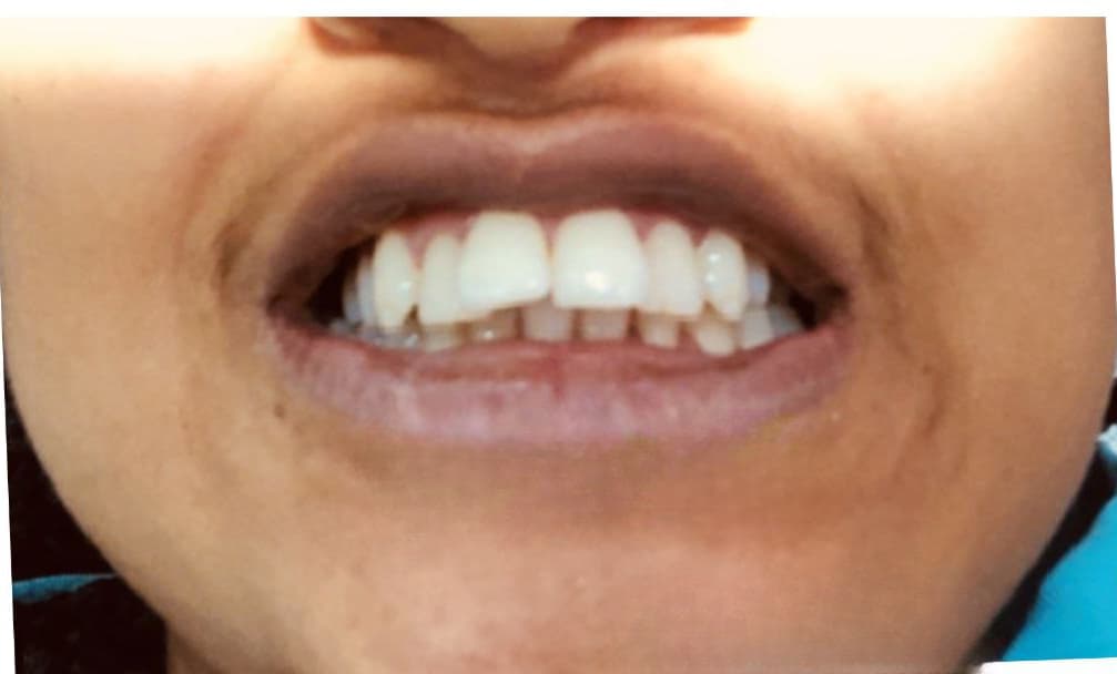 Before - Teen patient with severe crowding successfully treated with metal braces over 18 months.