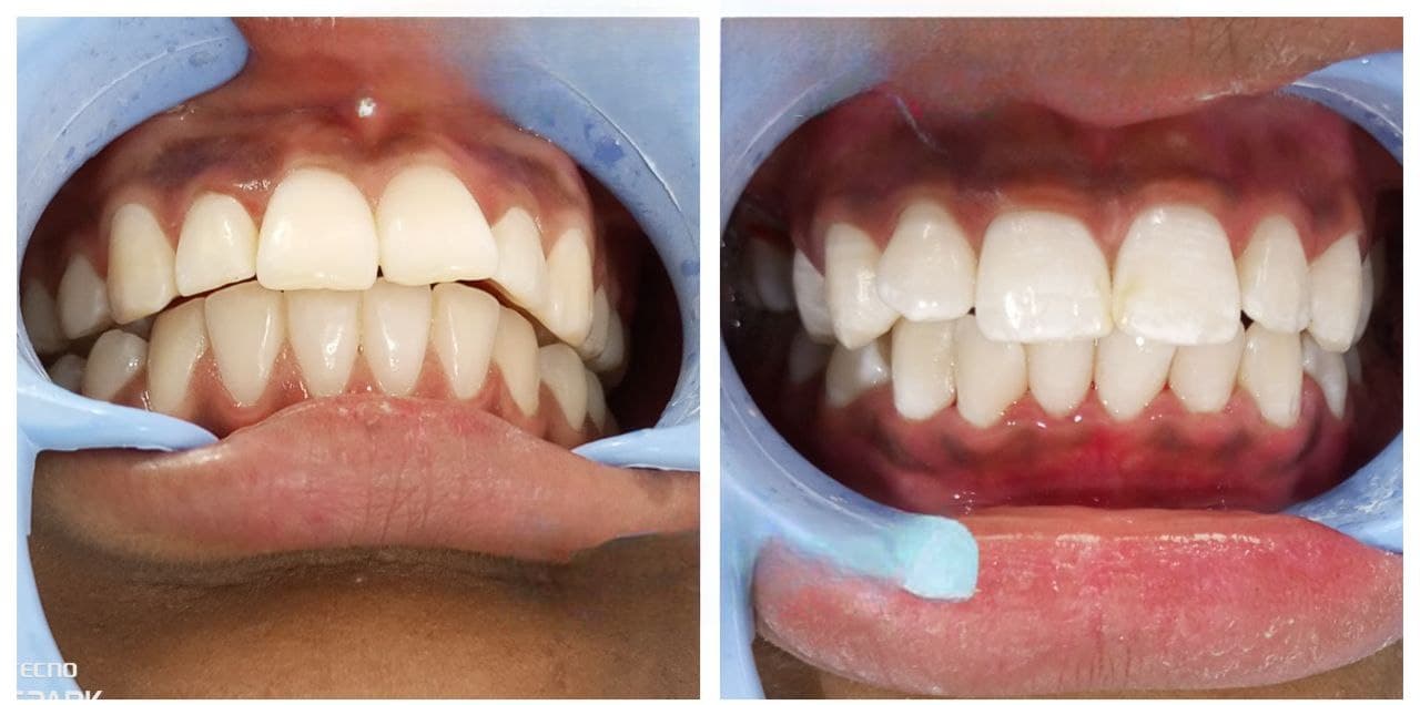 Before - Adult patient corrected overbite using Invisalign over a 14-month period.