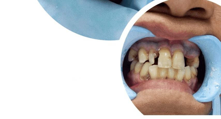 Before - Molar with deep decay treated with root canal and crowned for long-term protection.