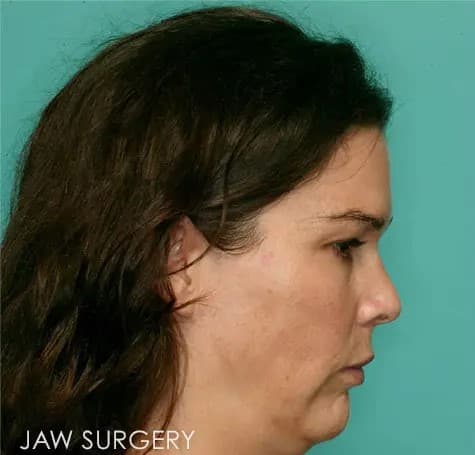 Before - Receding jaw fixed with jaw sugery.