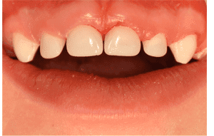 After - Decay on primary molars treated with esthetic white fillings for a clean, healthy smile.