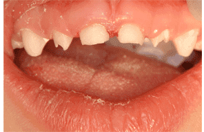 Before - Decay on primary molars treated with esthetic white fillings for a clean, healthy smile.