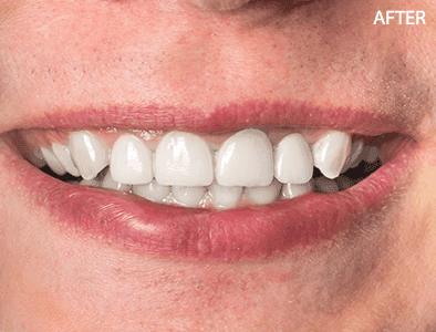 After - Full-mouth reconstruction with crowns and bridges for a patient with worn and missing teeth.