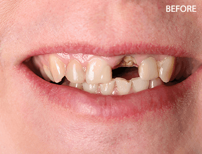 Before - Full-mouth reconstruction with crowns and bridges for a patient with worn and missing teeth.